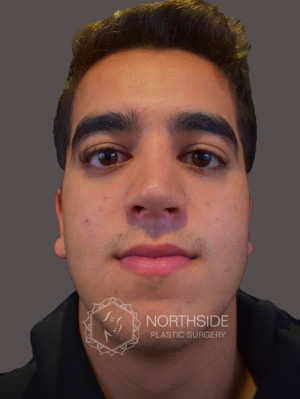 Ethnic Rhinoplasty Before and After | Northside Plastic Surgery