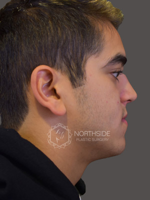 Ethnic Rhinoplasty Before and After | Northside Plastic Surgery