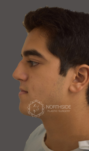 Ethnic Rhinoplasty Before and After | Northside Plastic Surgery