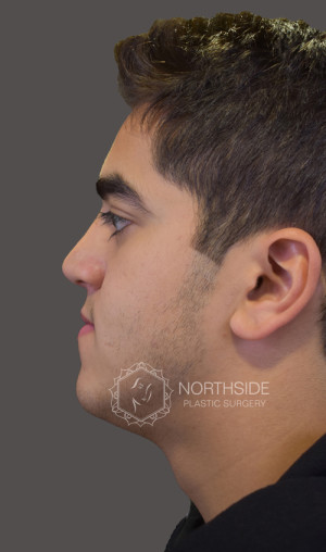 Ethnic Rhinoplasty Before and After | Northside Plastic Surgery