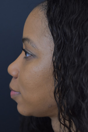 Ethnic Rhinoplasty Before and After | Northside Plastic Surgery