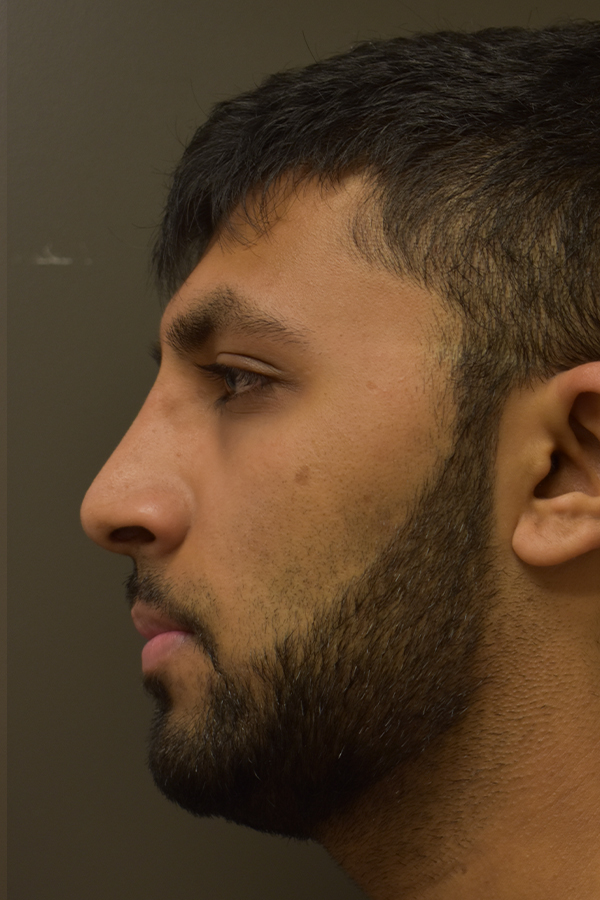 Ethnic Rhinoplasty Before and After | Northside Plastic Surgery