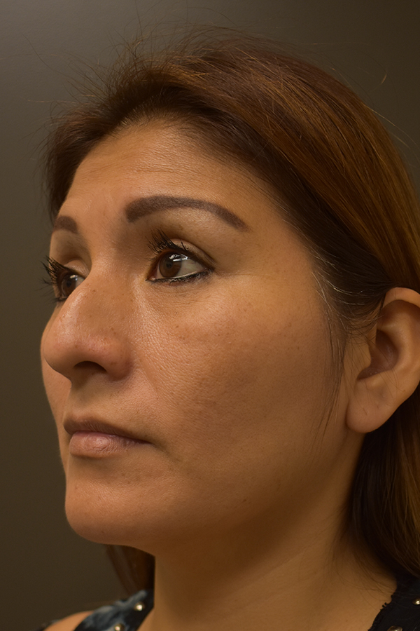 Ethnic Rhinoplasty Before and After | Northside Plastic Surgery