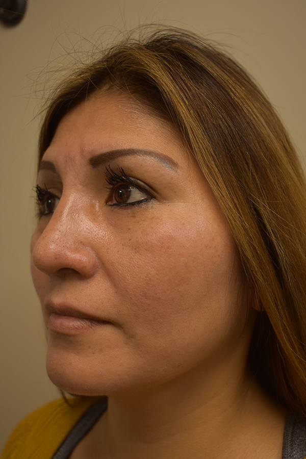 Ethnic Rhinoplasty Before and After | Northside Plastic Surgery