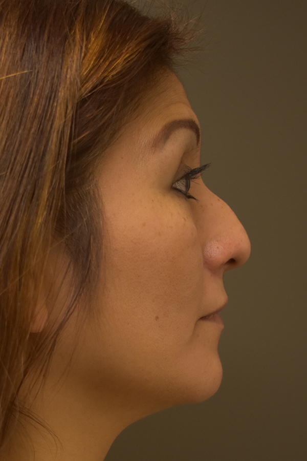 Ethnic Rhinoplasty Before and After | Northside Plastic Surgery