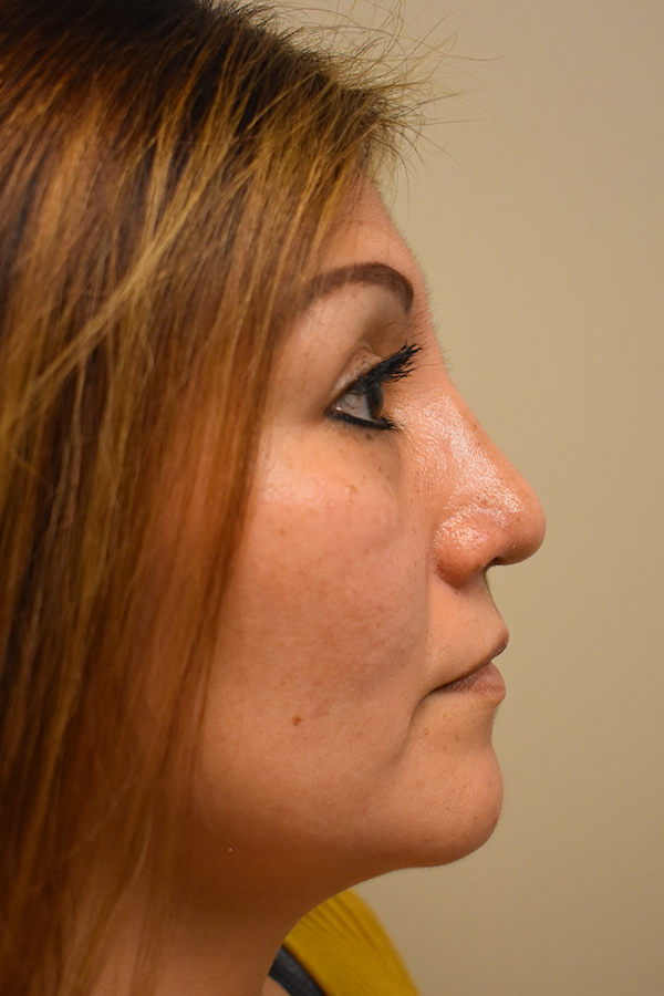 Ethnic Rhinoplasty Before and After | Northside Plastic Surgery