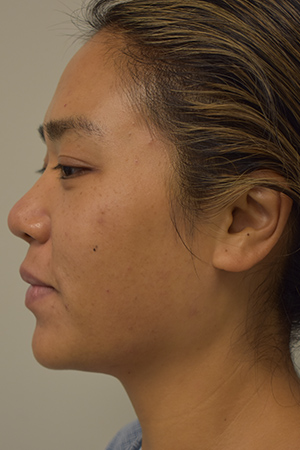 Ethnic Rhinoplasty Before and After | Northside Plastic Surgery