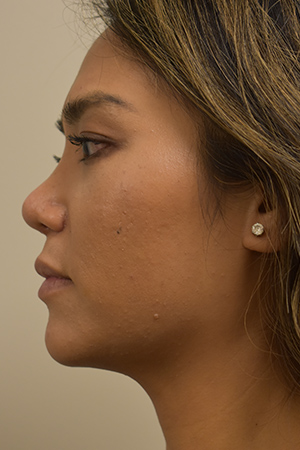 Ethnic Rhinoplasty Before and After | Northside Plastic Surgery