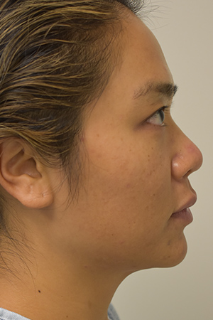 Ethnic Rhinoplasty Before and After | Northside Plastic Surgery