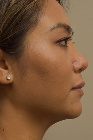 Ethnic Rhinoplasty Before and After | Northside Plastic Surgery