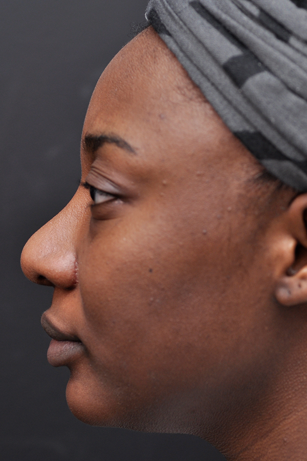 Ethnic Rhinoplasty Before and After | Northside Plastic Surgery