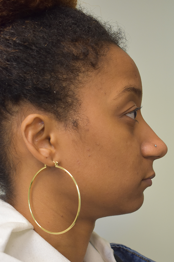 Ethnic Rhinoplasty Before and After | Northside Plastic Surgery