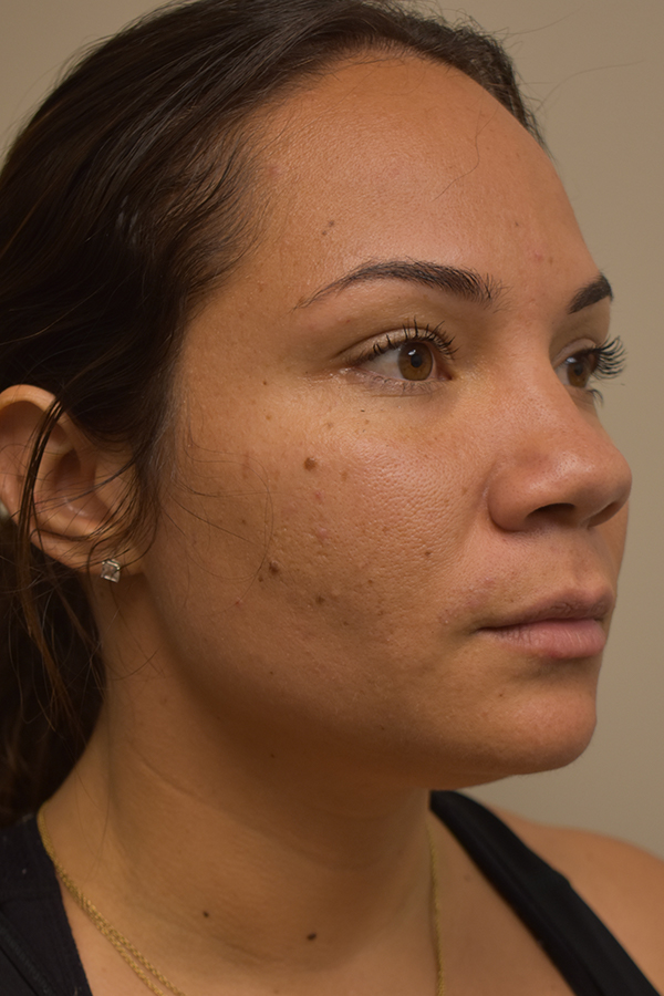 Ethnic Rhinoplasty Before and After | Northside Plastic Surgery