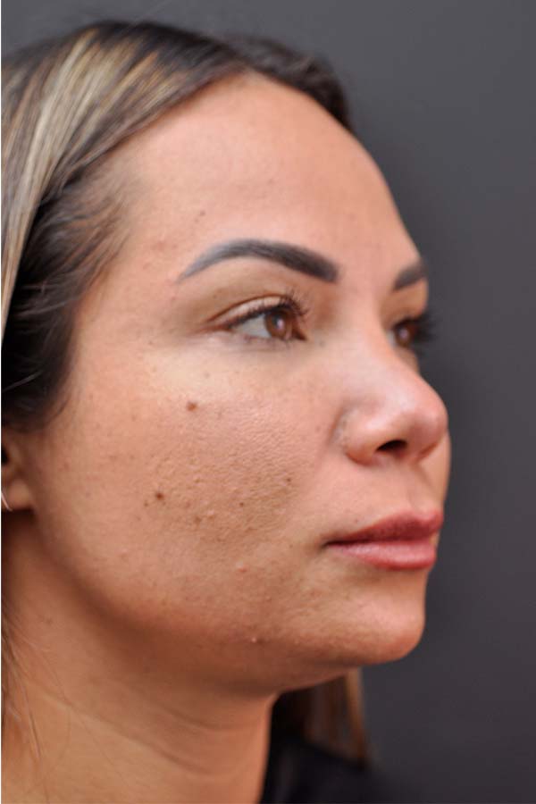 Ethnic Rhinoplasty Before and After | Northside Plastic Surgery