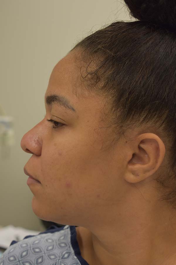 Ethnic Rhinoplasty Before and After | Northside Plastic Surgery