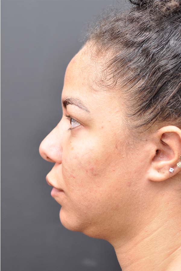 Ethnic Rhinoplasty Before and After | Northside Plastic Surgery