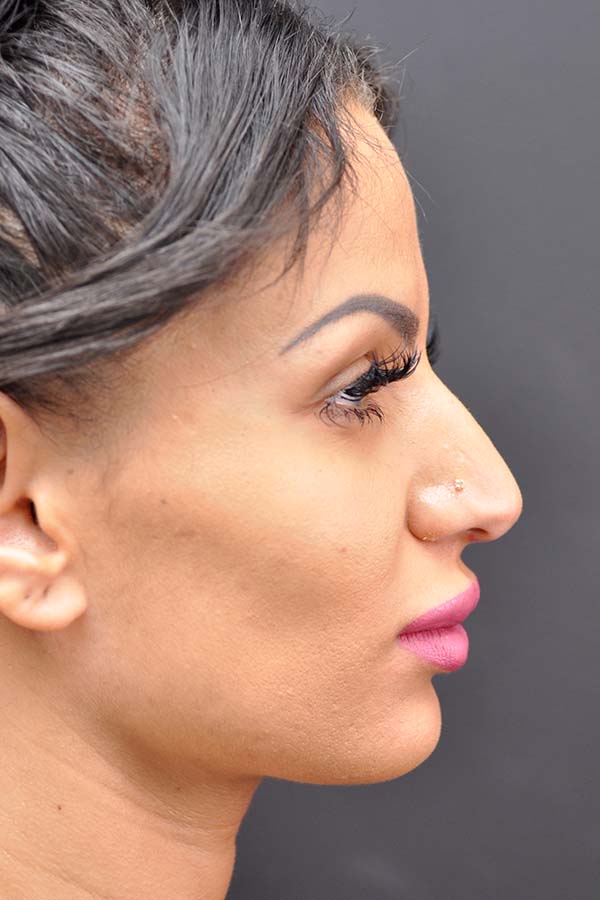 Ethnic Rhinoplasty Before and After | Northside Plastic Surgery