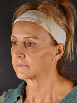 Fat Transfer Before and After | Northside Plastic Surgery