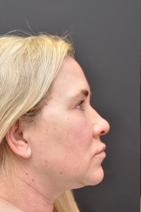 Fat Transfer Before and After | Northside Plastic Surgery