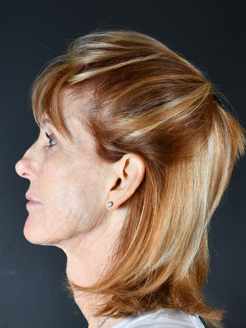 Fat Transfer Before and After | Northside Plastic Surgery