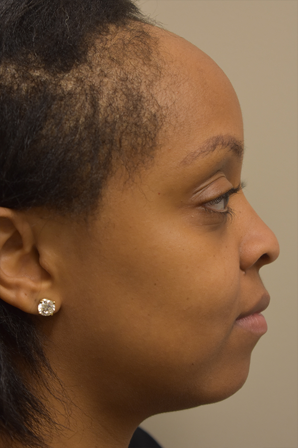 Hairline Lowering Surgery Before and After | Northside Plastic Surgery
