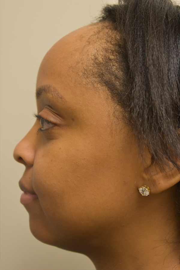 Hairline Lowering Surgery Before and After | Northside Plastic Surgery