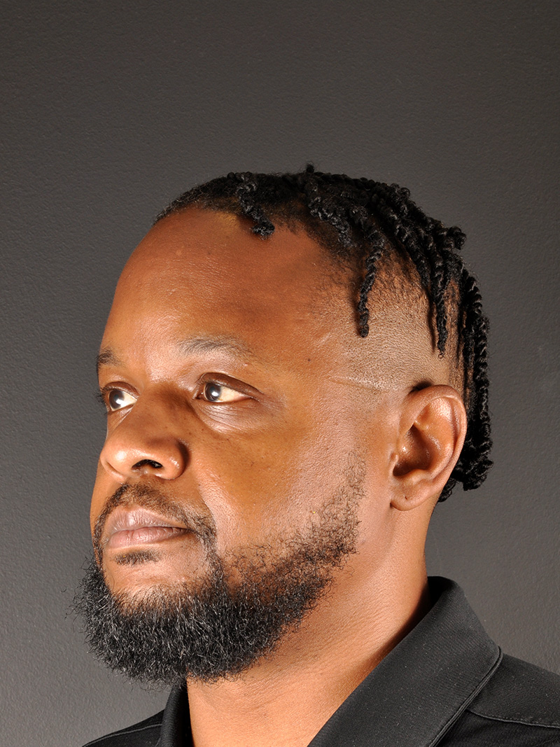 Hairline Lowering Surgery Before and After | Northside Plastic Surgery