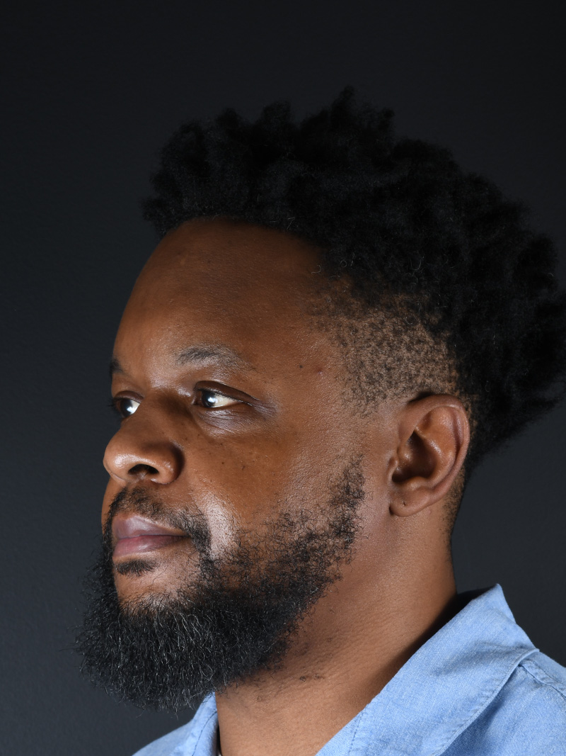 Hairline Lowering Surgery Before and After | Northside Plastic Surgery