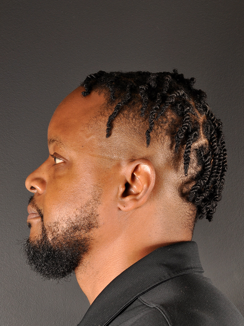 Hairline Lowering Surgery Before and After | Northside Plastic Surgery