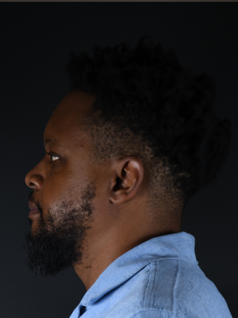 Hairline Lowering Surgery Before and After | Northside Plastic Surgery