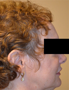 Hairline Lowering Surgery Before and After | Northside Plastic Surgery