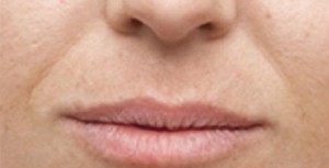Juvederm Before and After | Northside Plastic Surgery
