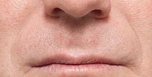 Juvederm Before and After | Northside Plastic Surgery