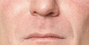 Juvederm Before and After | Northside Plastic Surgery