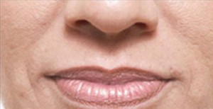 Juvederm Before and After | Northside Plastic Surgery