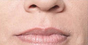 Juvederm Before and After | Northside Plastic Surgery