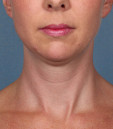 Kybella Before and After | Northside Plastic Surgery