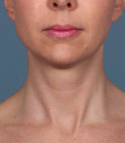 Kybella Before and After | Northside Plastic Surgery