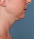 Kybella Before and After | Northside Plastic Surgery