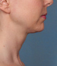 Kybella Before and After | Northside Plastic Surgery