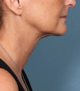 Kybella Before and After | Northside Plastic Surgery