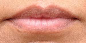 Lip Lift Before and After | Northside Plastic Surgery