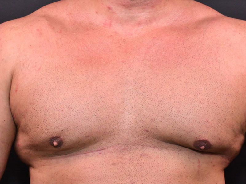 Before and After Liposuction in Atlanta