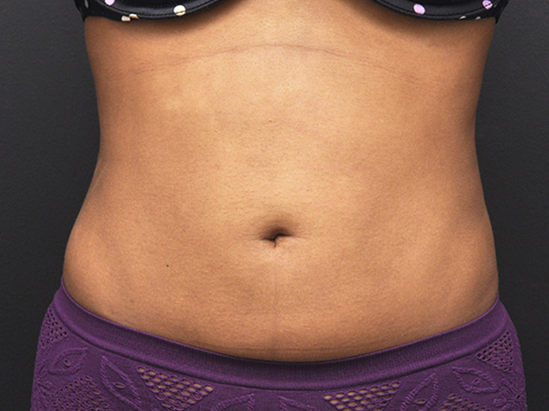 Liposuction Before and After | Northside Plastic Surgery