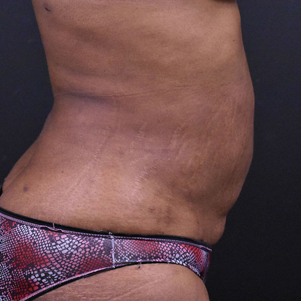 Liposuction Before and After | Northside Plastic Surgery