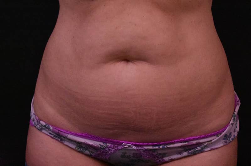 Liposuction Before and After | Northside Plastic Surgery