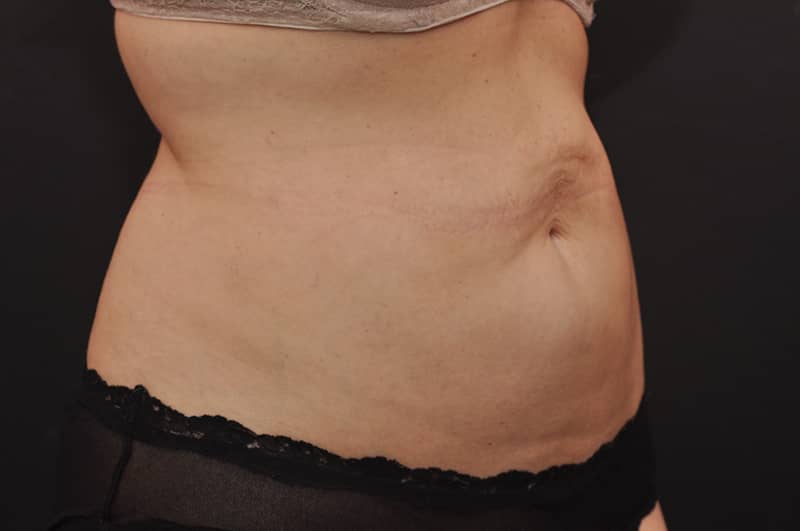 Liposuction Before and After | Northside Plastic Surgery