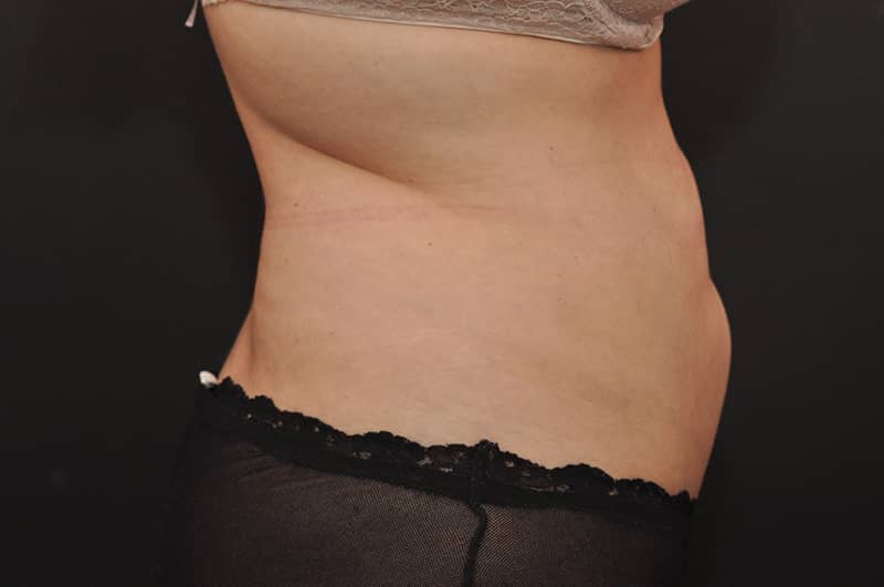 Liposuction Before and After | Northside Plastic Surgery