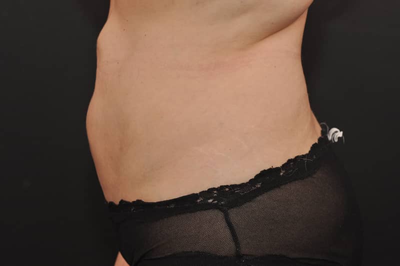 Liposuction Before and After | Northside Plastic Surgery