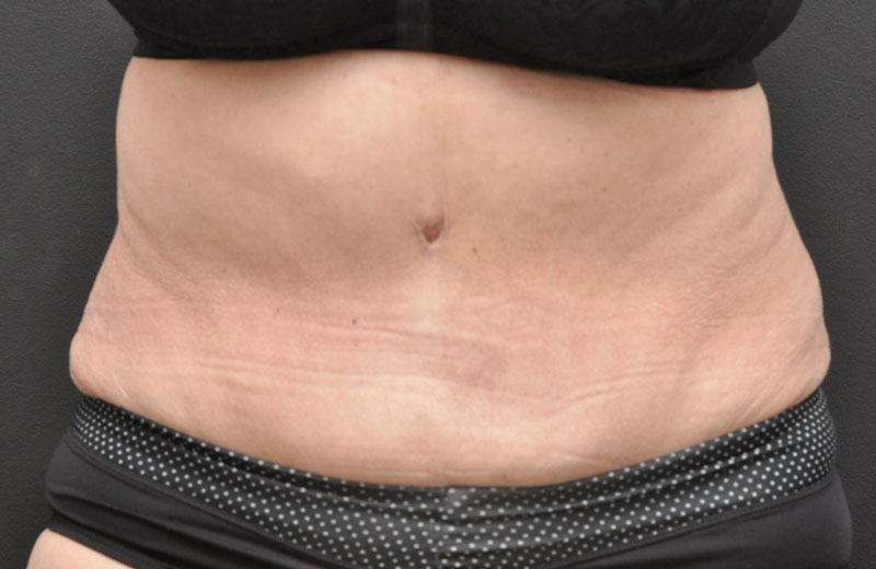 Liposuction Before and After | Northside Plastic Surgery